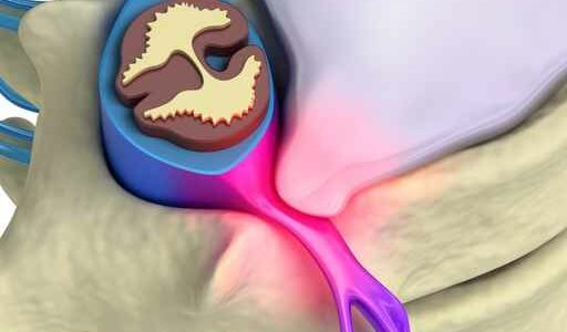 Hernia manueel Hernia manueel